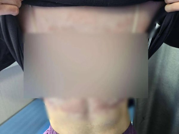 大牛时代配资 母子相继患“怪病”! 红斑爬满全身, 元凶很多人都在用